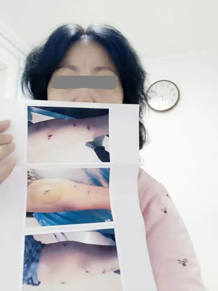 女子被狗咬伤，辗转打疫苗花费2万多